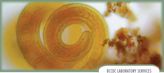 trichinosis in the eye