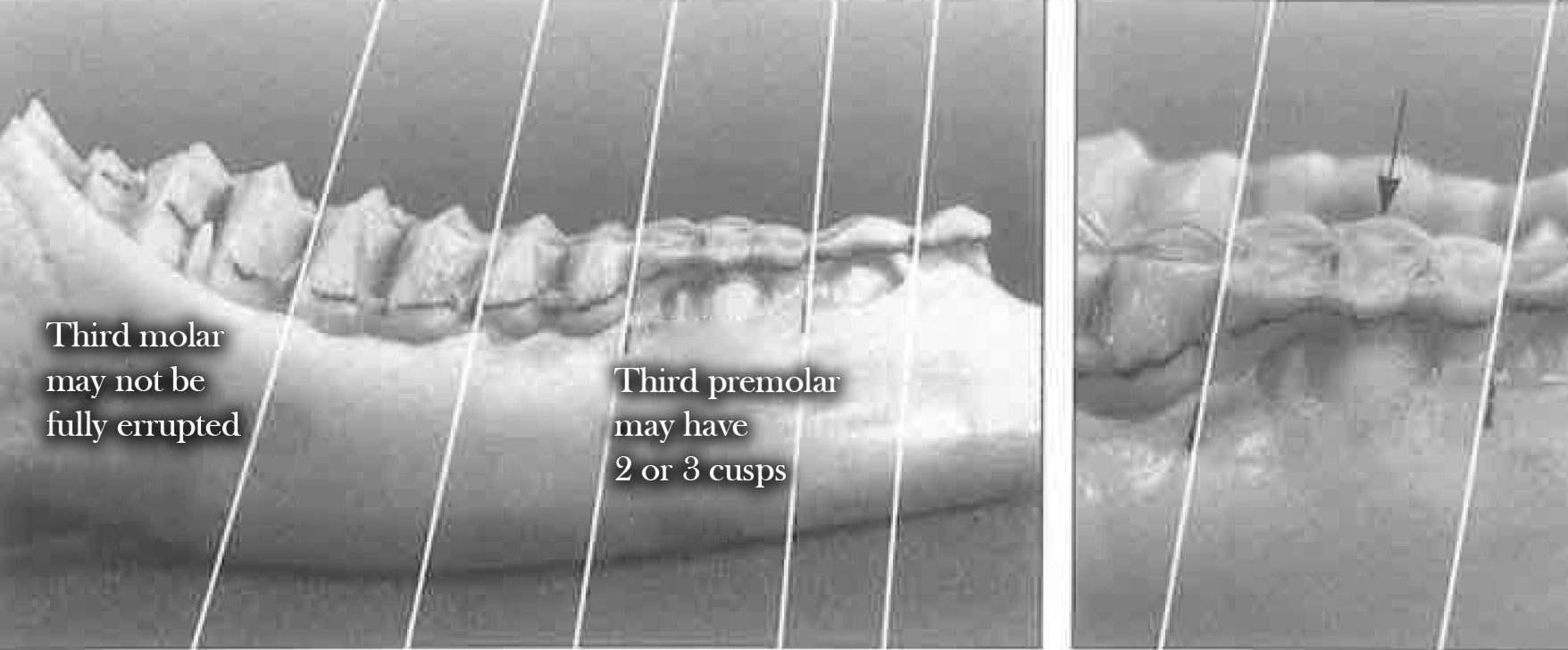 Teeth at 1.5 years of age