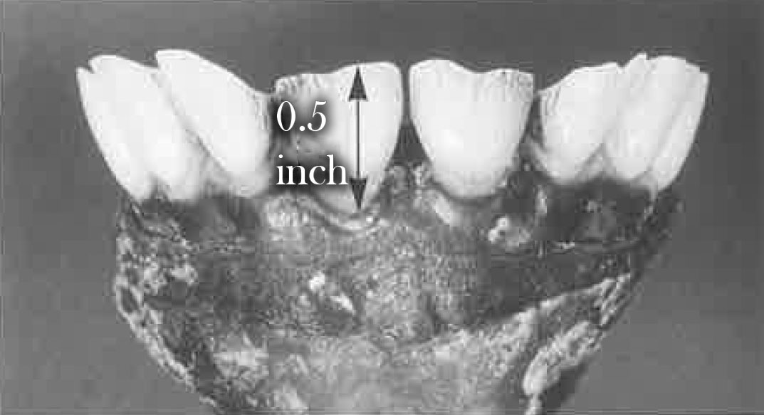 Incisors at 4.5 - 8.5 years of age