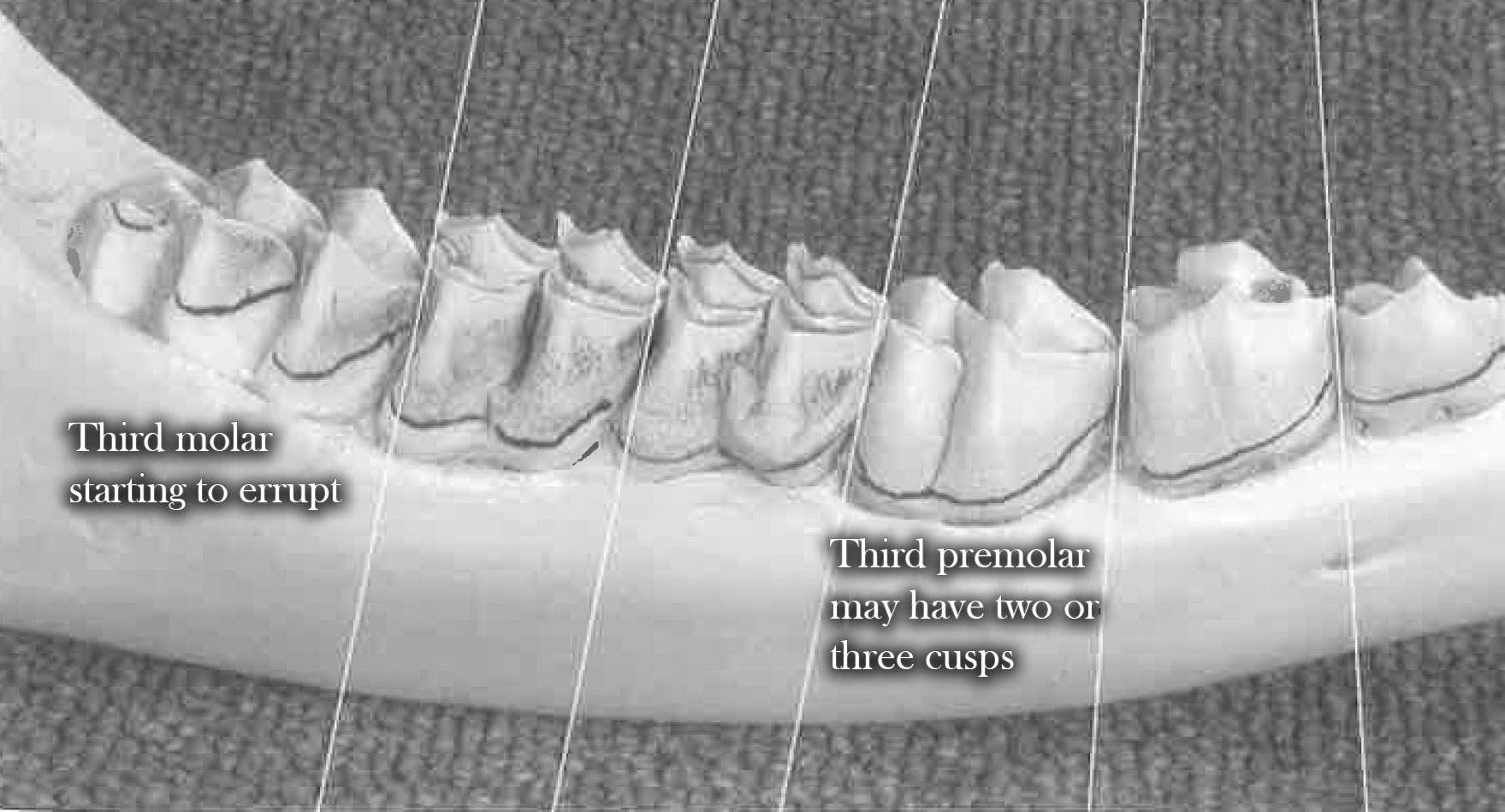 Teeth at 1.5 years of age