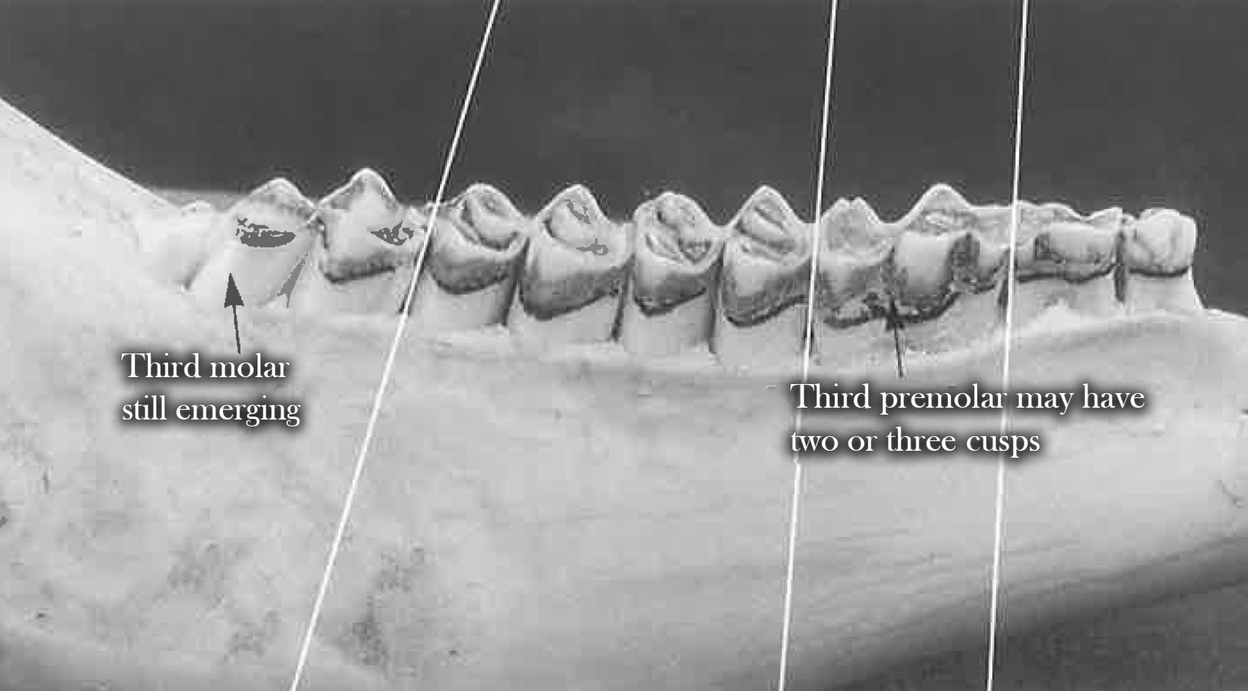 Teeth at 1.5 years of age